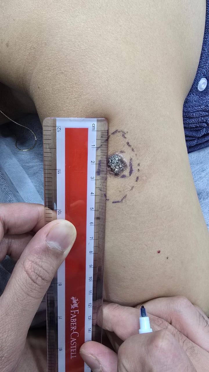 Bowen disease lesion pre-surgical marking